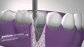 Currettage  Cliniche Dentali Dentix [upl. by Miranda667]