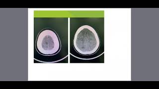 Eosinophilic granulomatosis with polyangiitis EGPA [upl. by Azalea]