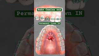 Baby Canine out permanent Crown IN by Braces  Retraction [upl. by Donnenfeld]