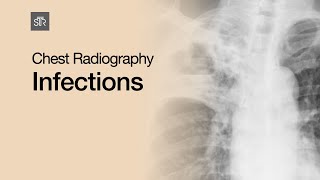 Chest Radiography Infections [upl. by Consalve]