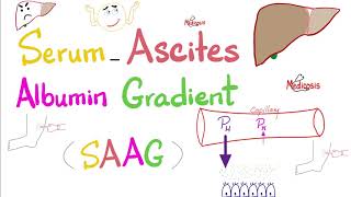 Serum Ascites Albumin Gradient SAAG  Peritoneal Effusion  Lab 🧪 [upl. by Frieder725]