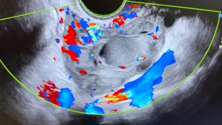 Ultrasound of acute salpingitis thick vascular fallop tube endometriotic simple amp nabothian cyst [upl. by Eiddam]