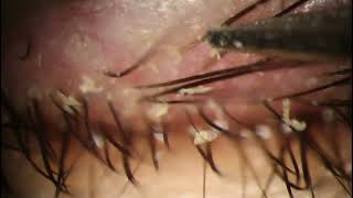 Blepharitis Cleaning  HUGE Plaques Removed at 325 [upl. by Darrill282]