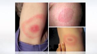 Lyme Disease Pictures  wikiSymptoms [upl. by Bertie562]