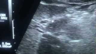 study of LIGAMENTUM TERES on ultrasound [upl. by Novehc]