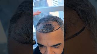 Rare hair transplant Balding behind the forelock post op vincihairclinic shorts [upl. by Revolc618]