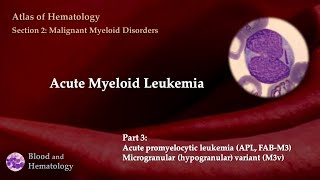 Acute Myeloid Leukemia AML  Part 3 [upl. by Volpe]