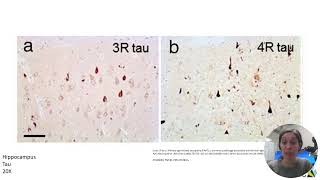 Neuropathology  Part 2 [upl. by Hael]