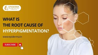 Podcast What is the root cause of hyperpigmentation Epiderma Skin and Hair Clinic in Jayanagar [upl. by Musa]