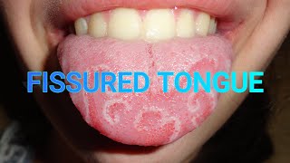 Fissured Tongue  Causes  Symptoms  Signs [upl. by Norbert]