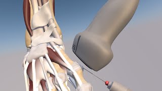 3D Model of a Ultrasound Guided First Metatarsophalangeal Joint Injection by probeultrasound [upl. by Uda792]