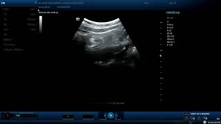 Appendicitis  ultrasound cases [upl. by Alrrats]