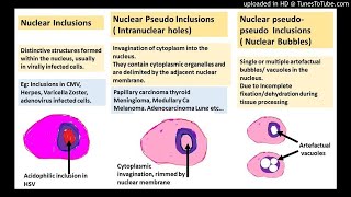 Nuclear pseudoinclusions NPIs  melanomameningiomapapillary thyroid carcinoma [upl. by Rozanne816]