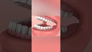 Wisdom tooth problem dentist teeth [upl. by Ybbor]