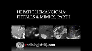 Hepatic Hemangioma Pitfalls amp Mimics Part I [upl. by Spanos]