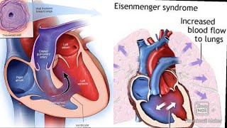 Eisenmenger syndrome fmge next neetpg [upl. by Nea302]