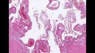 Histopathology GallbladderAcute cholecystitis [upl. by Ulrika6]