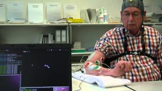 BrainComputer interface used for rehabilitation after a stroke [upl. by Eerdua]