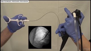 Transbronchial Biopsies  BAVLS [upl. by Georgeanna]