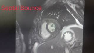 Septal Bounce in Cardiac MRI [upl. by Idet128]