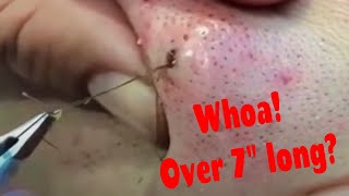 Hairy Situations Ingrown hairs infected follicles pops  more [upl. by Gretal]