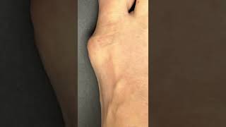 Before and After Minimally Invasive Bunion Surgery [upl. by Lacie]