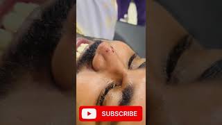 Laser Mole Removal  Mole तिल kaise nikale shortvideo viral doctor hospital skincare mole [upl. by Quick]