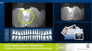 KaVo DIAGNOcam Strahlungsfreie Kariesdiagnostik [upl. by Sudoeht]