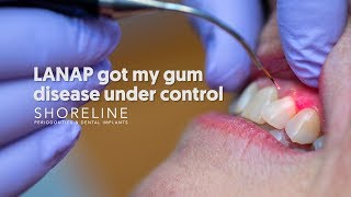 Treat periodontal disease with less pain Dr Urbanski explains the LANAP procedure [upl. by Horan]