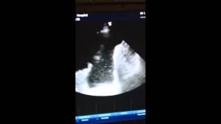 Thoracic USS  Complex pleural effusion [upl. by Ladiv]