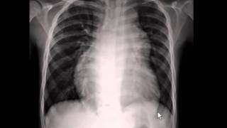 Chest xray  pulmonary arterial hypertension [upl. by Lienet]