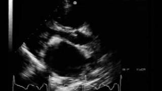 MS different aspectscalcified mitral stenosis [upl. by Stanwinn433]