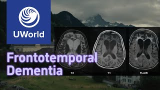 Frontotemporal Dementia vs Alzheimer Disease with Histology  UWorld USMLE MBBS [upl. by Moishe]