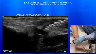 Ultrasound Guided Aspiration and Cortisone Injection of a Ganglion Abutting the Distal Fibula [upl. by Florence294]