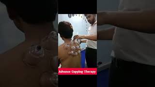 Cupping Therapy Cervicalpain shortvideo physiotherapy [upl. by Oyek]