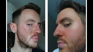 How Matt Healed his Eczema and Overcame Topical Steroid Withdrawal [upl. by Yramesor]