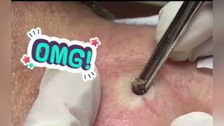 Ultimate Ear Blackheads Extraction Watch the Magic Happen [upl. by Lais]