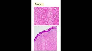 ShortsExam slideselongated cells keloidleiomyoma hyaline change Dr GSS SRM MCH RC [upl. by Bedelia]