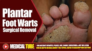 Foot Plantar Warts  Surgical Removal Treatment  How to Remove Plantar Warts ❌🦠 [upl. by Anirda158]