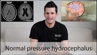 Normal Pressure Hydrocephalus \\ everything you need to know [upl. by Cooperstein140]