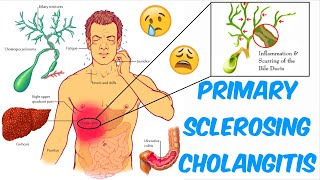 Primary Sclerosing Cholangitis PSC [upl. by Trever]