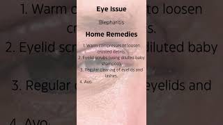 The Surprising Truth About Treating Blepharitis at Home [upl. by Illa746]