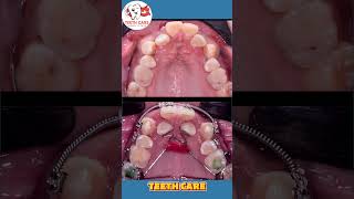 braces transformation teeth braces dental dentalcare dentalhealth dentalimplants shorts [upl. by Nallaf302]