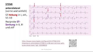 Herz 11 EKG 4  STEMI Perikarditis Extrasystole Kammerflimmern [upl. by Aicnom]