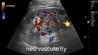 Renal cell carcinoma ultrasound and color Doppler video [upl. by Adriel]