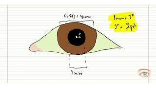 Hirschberg Test [upl. by Eileen]