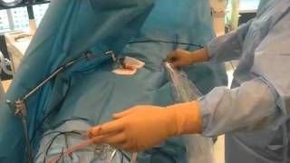 Micro endoscopic METRx spine surgery in Croatia  Part 5 [upl. by Ecyle634]