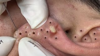 Big Cystic Acne Blackheads Extraction Blackheads amp Milia Whiteheads Removal Pimple Popping  3897 [upl. by Diskson79]