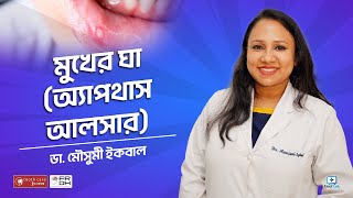 মুখের ঘা অ্যাপথাস আলসার Aphthous ulcer treatment bangla [upl. by Nirehs928]