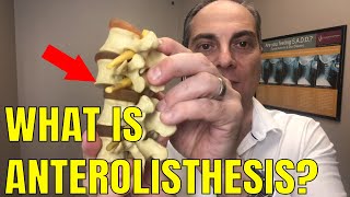 Ep61 What Does Anterolisthesis Of L5 Mean  Dr Walter Salubro Chiropractor in Vaughan [upl. by Earla]